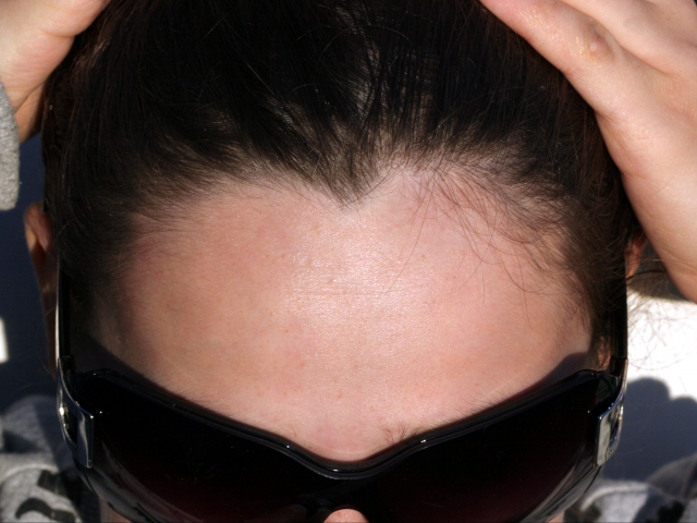 Do you have a widow's peak?